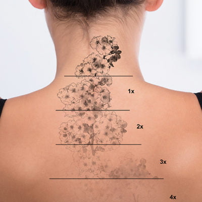 Laser Tattoo Removal & Saline Light