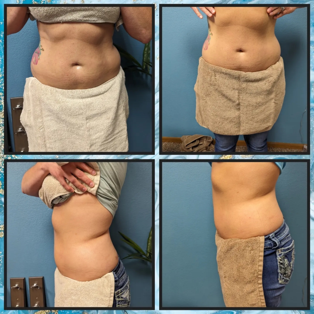 Fat Reduction Single Session
