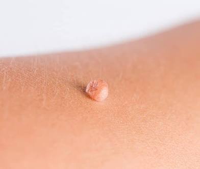 Skin Tag Removal