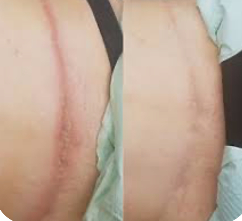 Scar camouflage tattooing