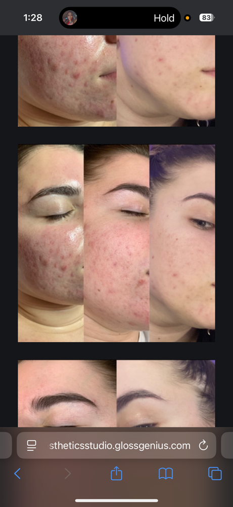 Acne Bootcamp Consult + Treatment