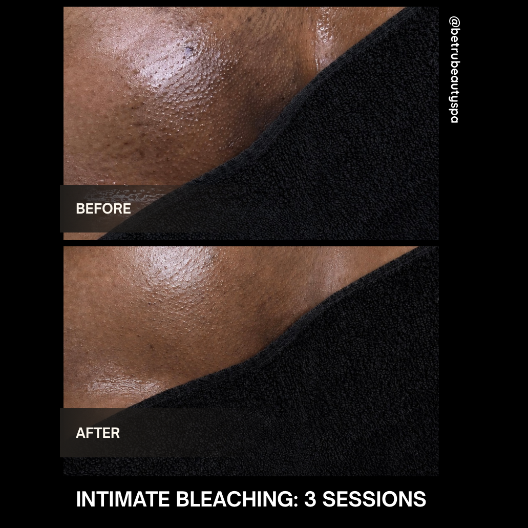 Intimate Bleaching at BE TRU BEAUTY SPA in Fairfield, CT