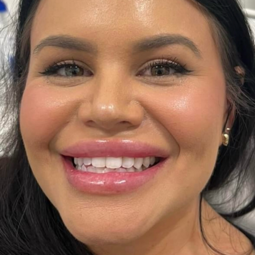 Supreme Whitening at Advanced Teeth Whitening Beauty Studio in Rockwall, TX