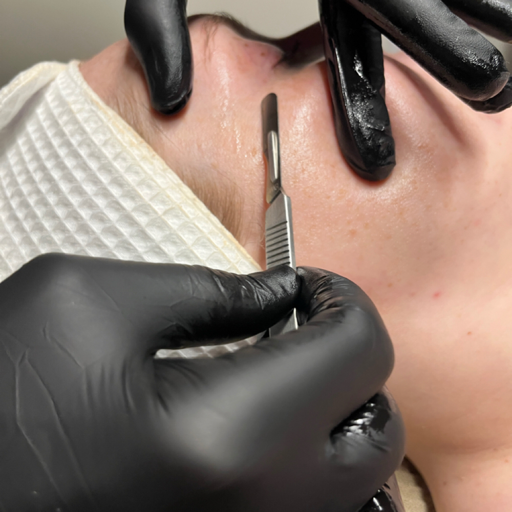 Dermaplaning Enhancement at Elegant Esthetics in Virginia Beach, VA
