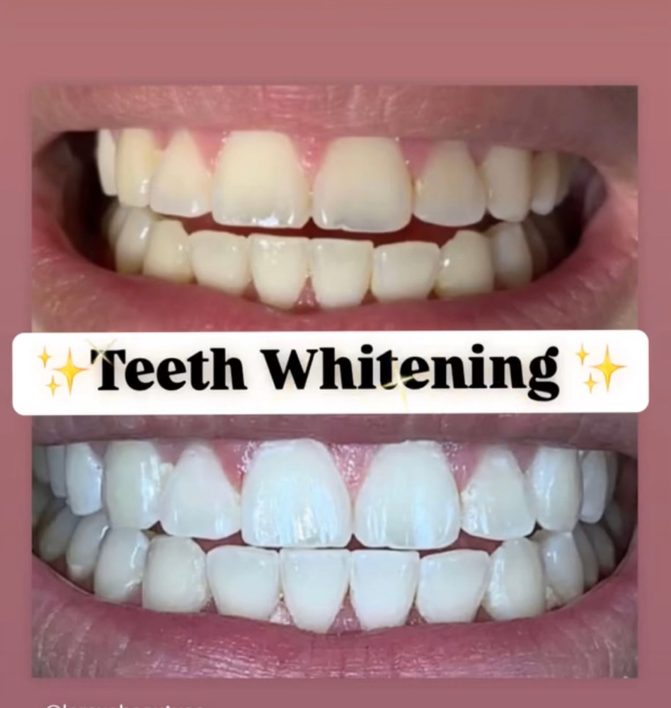 Express Teeth Whitening Session