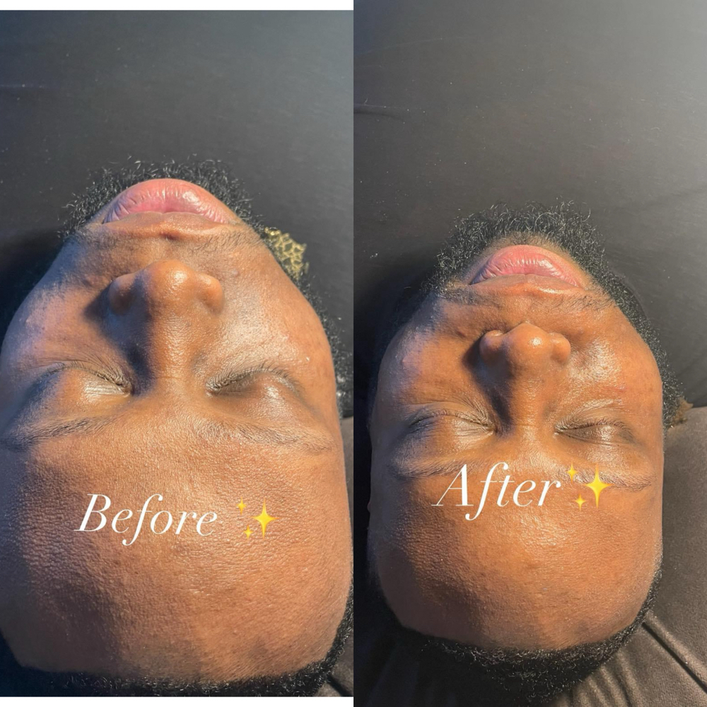 Facial