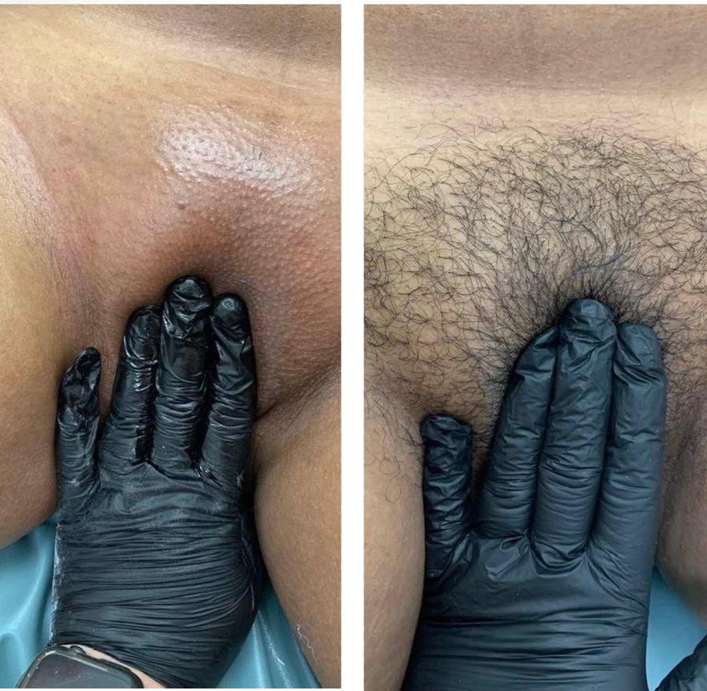 Brazilian Wax