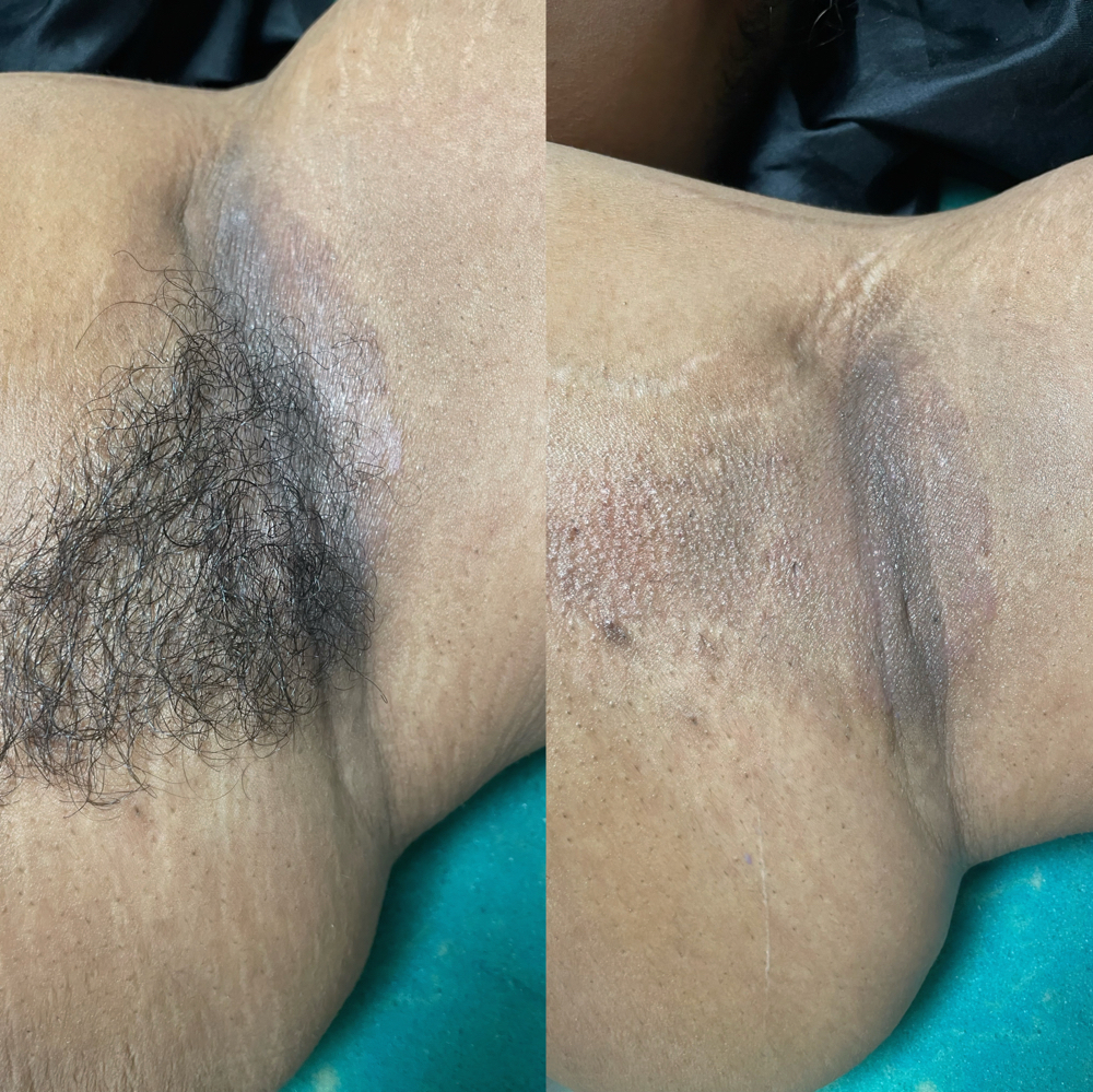 Underarm Wax