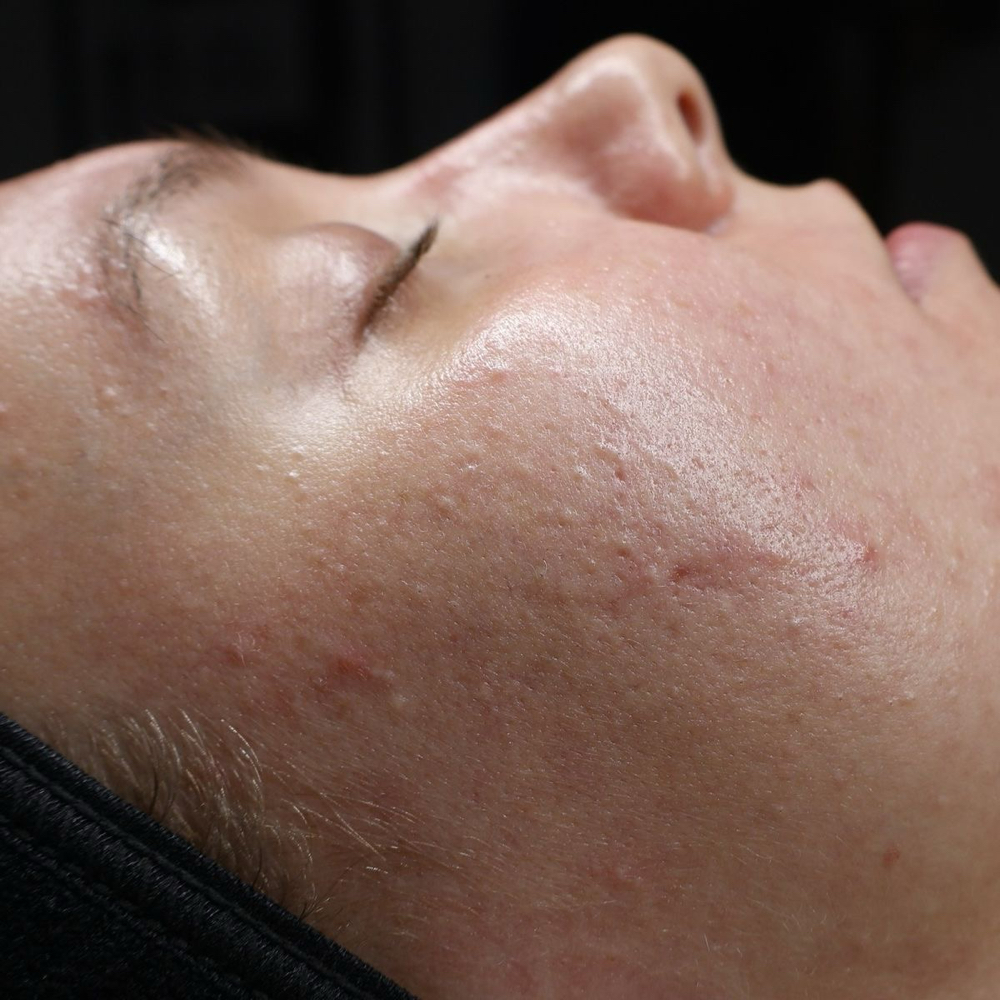 The Acne Facial