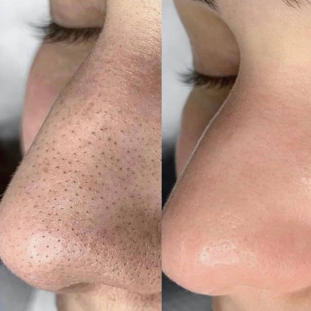 PORE EXTRACTION ADD ON at Vera Luna Beauty Collective in Rapid City, SD