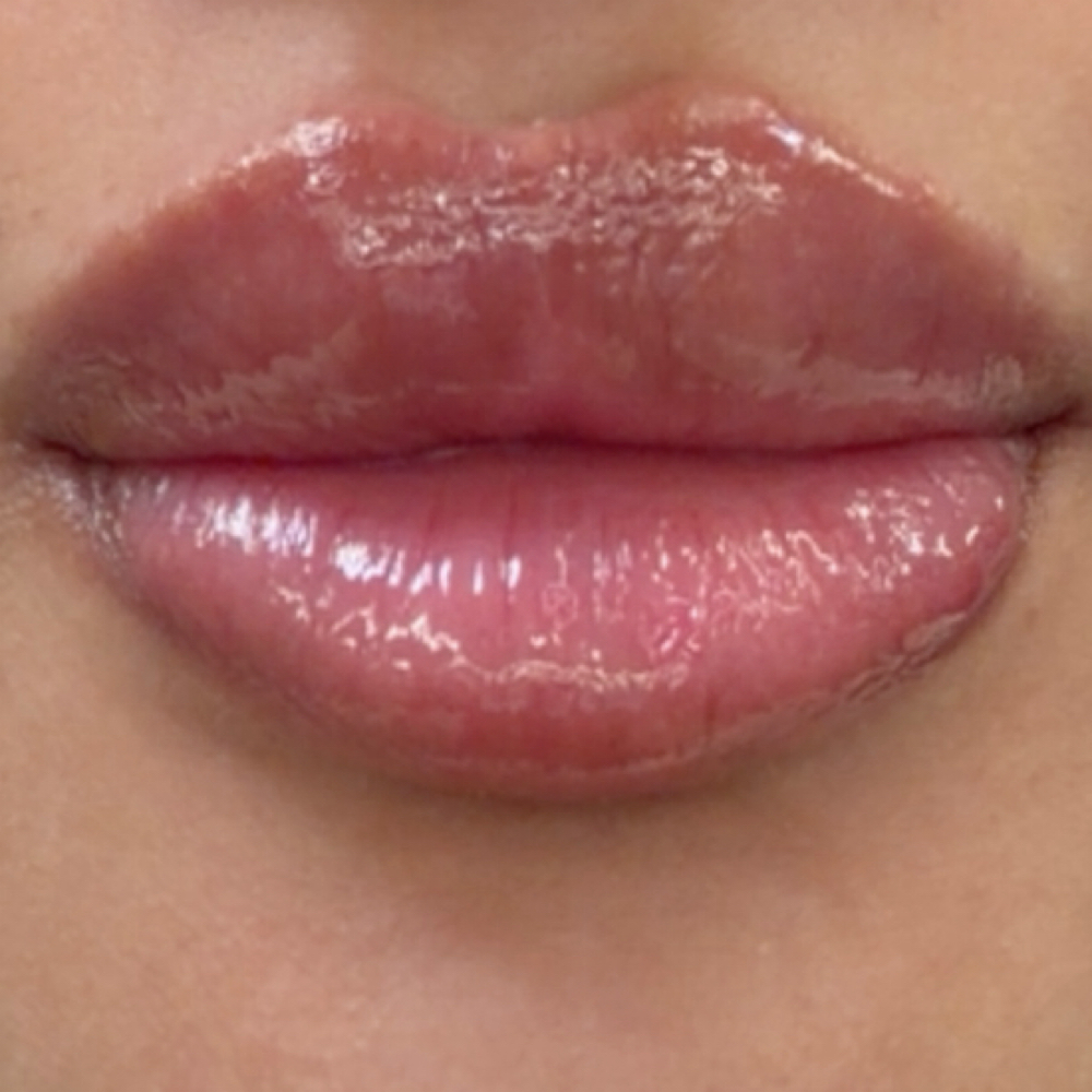 Lip Fillers at Zoraya Velez AESTHETICIAN in Richmond, VA