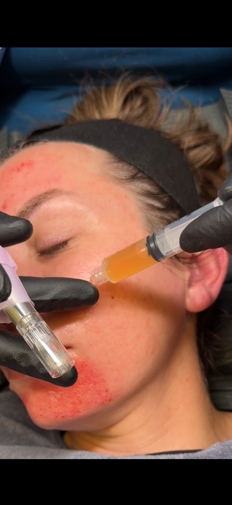 Traditional Microneedling