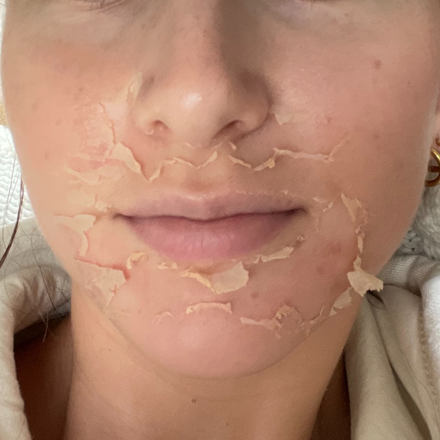 ZO 3 Step Peel at Skin Corrective Aesthetics in Dallas, TX
