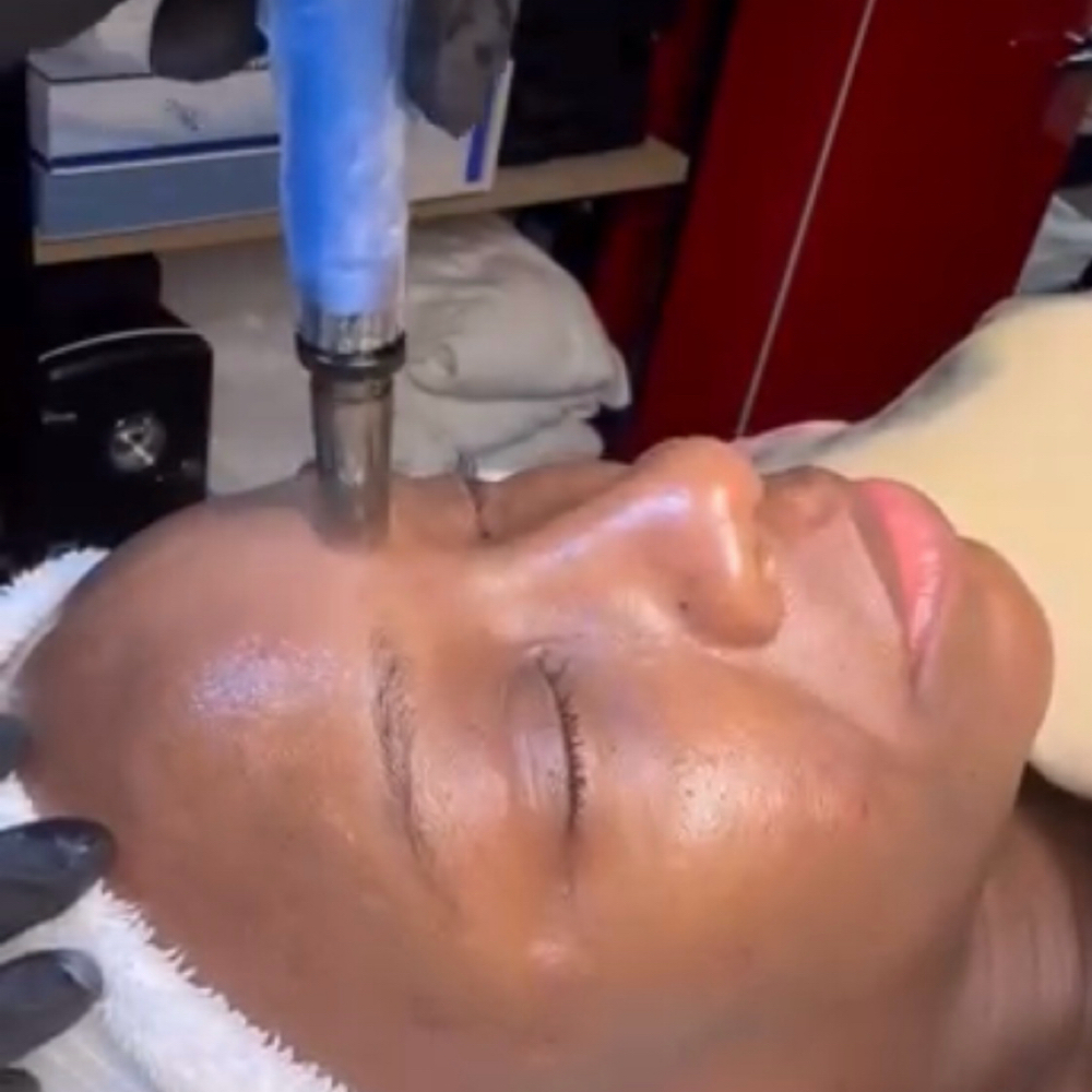 Microneedling at Skin Couture in Chicago, IL