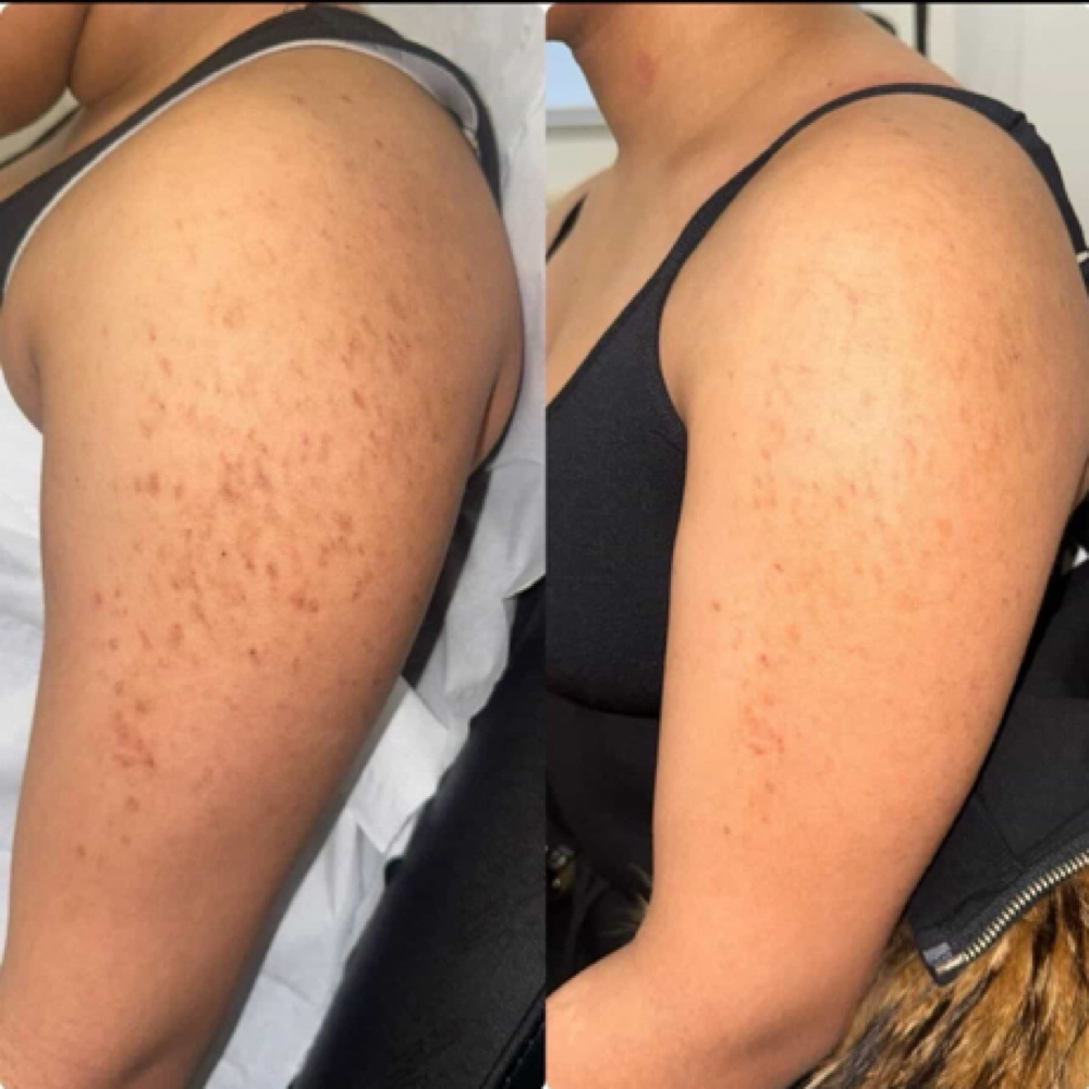 Organo Herbal Peel (Body) at Sonder Skin in Newport News, VA