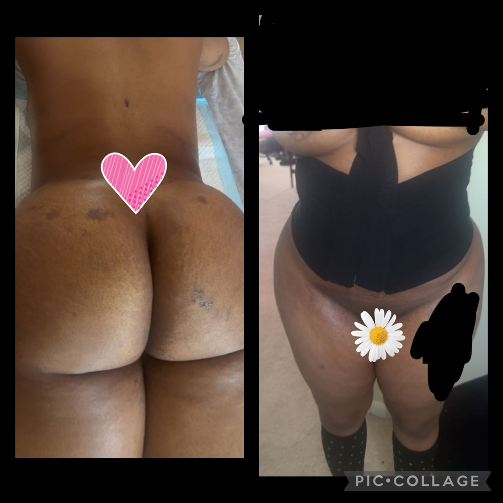 Taping (Ten Day ) Slimming at N'Vestd Aesthetics in Fairfeild, OH