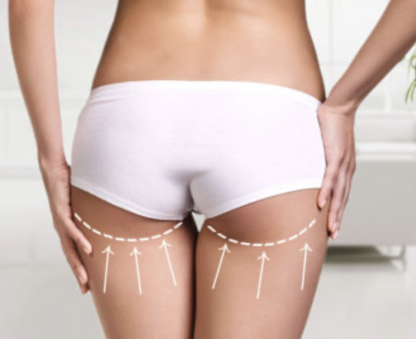 Vacuum Buttock Lift Treatment