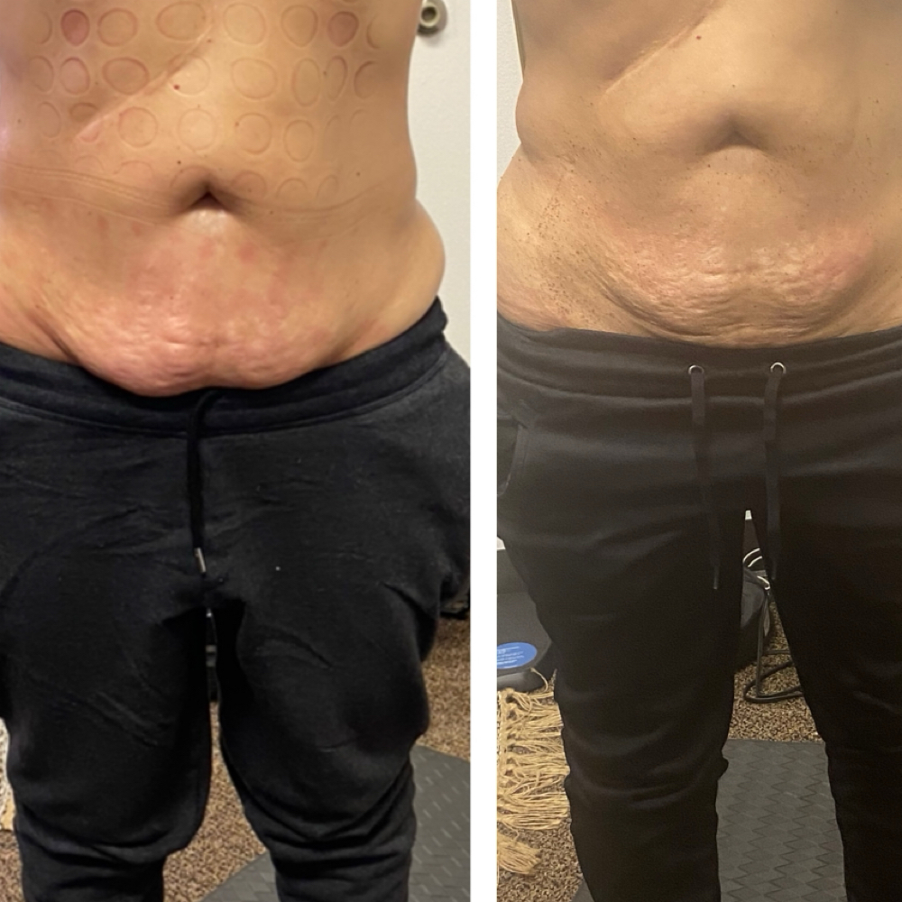 Non Invasive Tummy Tuck(3 Sessions) at 210 The Body Bar | San Antonio Lux Spray Tans & Body Sculpting in San Antonio, TX