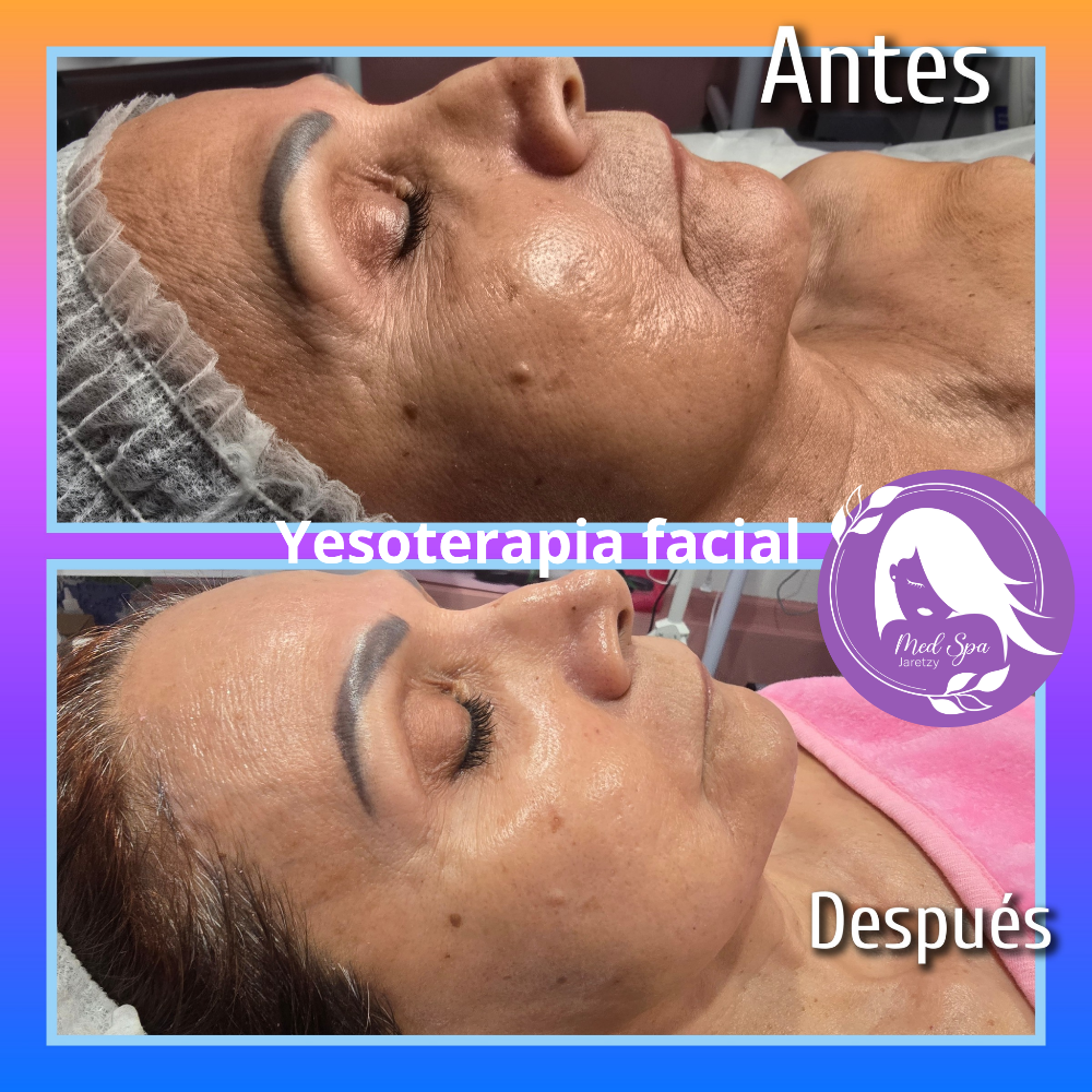 Dermaplaning Y Yesoterapia