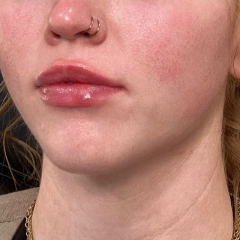 Lip Filler at Alchemy Aesthetics + MedSpa in Overland Park, KS