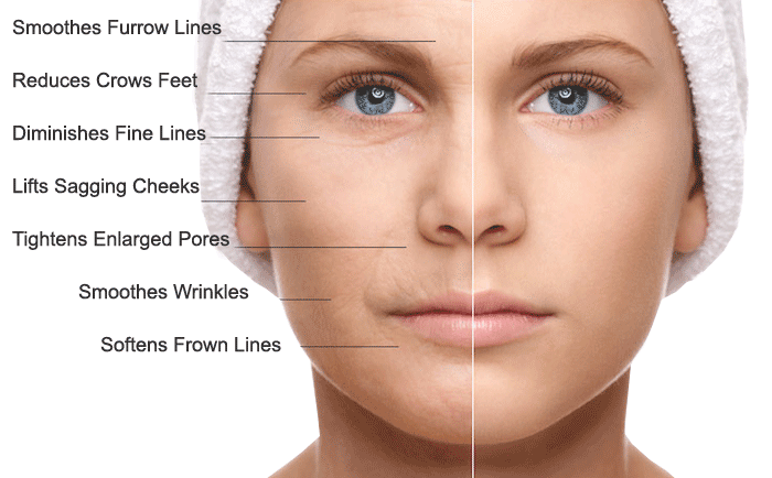 Microneedling