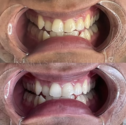 Express Whitening