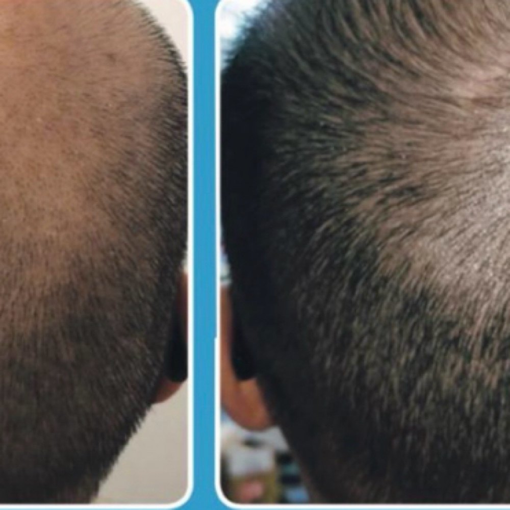 Redeemed Radiance Hair Restoration at Redeemed Radiance Aesthetics & Cosmetic Injections in San Antonio, TX