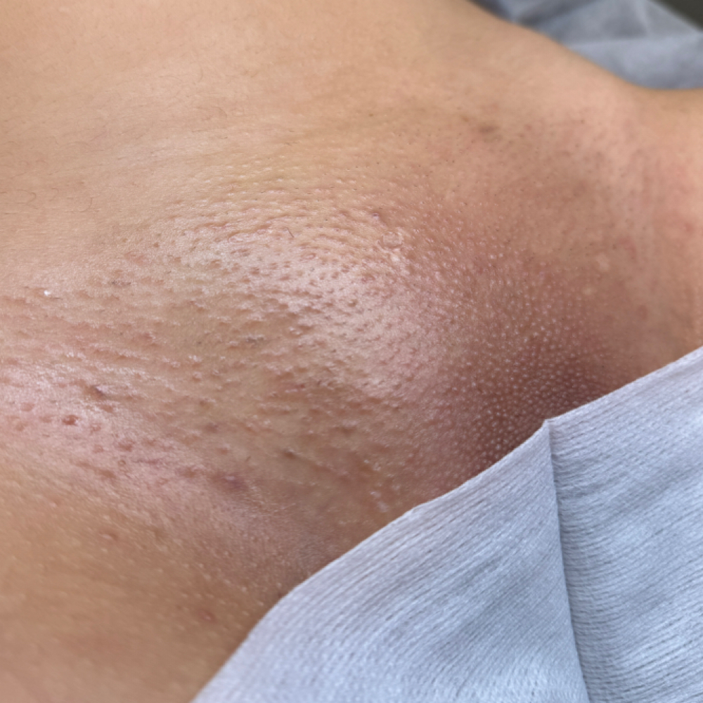 Waxing - Brazilian at Blissful Skin LLC in Glendale, AZ