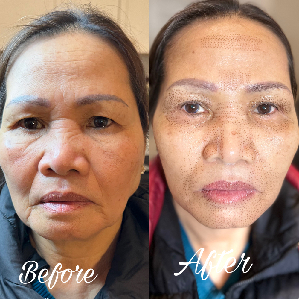 Full Face Lifting fibroblast Plasma