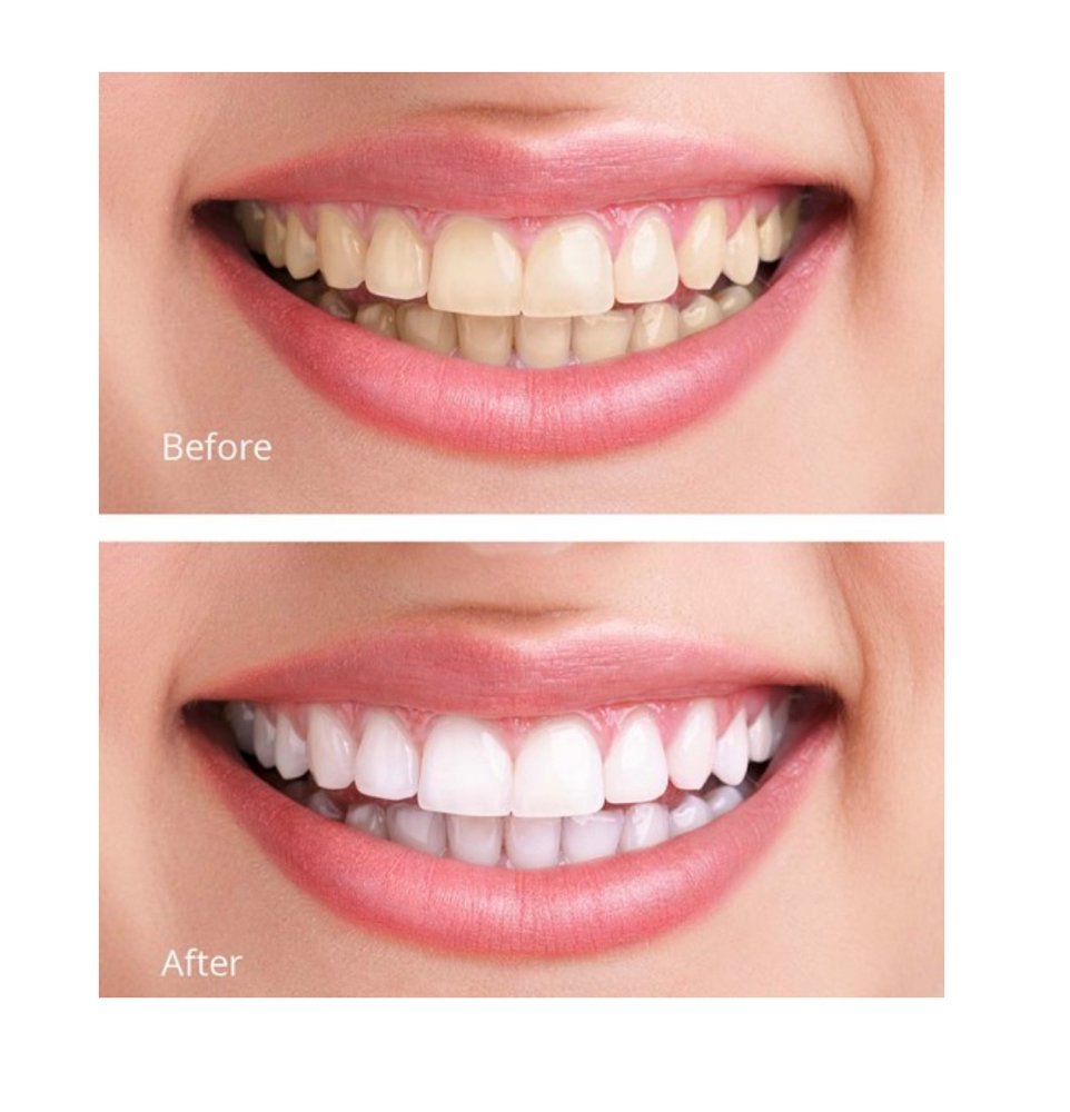 60 Minute Teeth Whitening