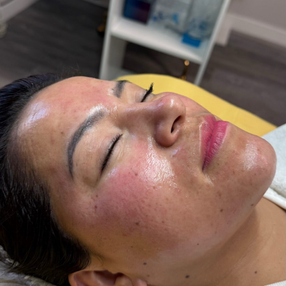 Exosomas at Any Beauty Aesthetics Care in New York, NY