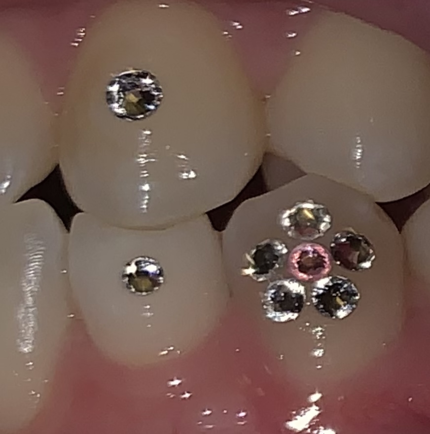 Tooth Gems