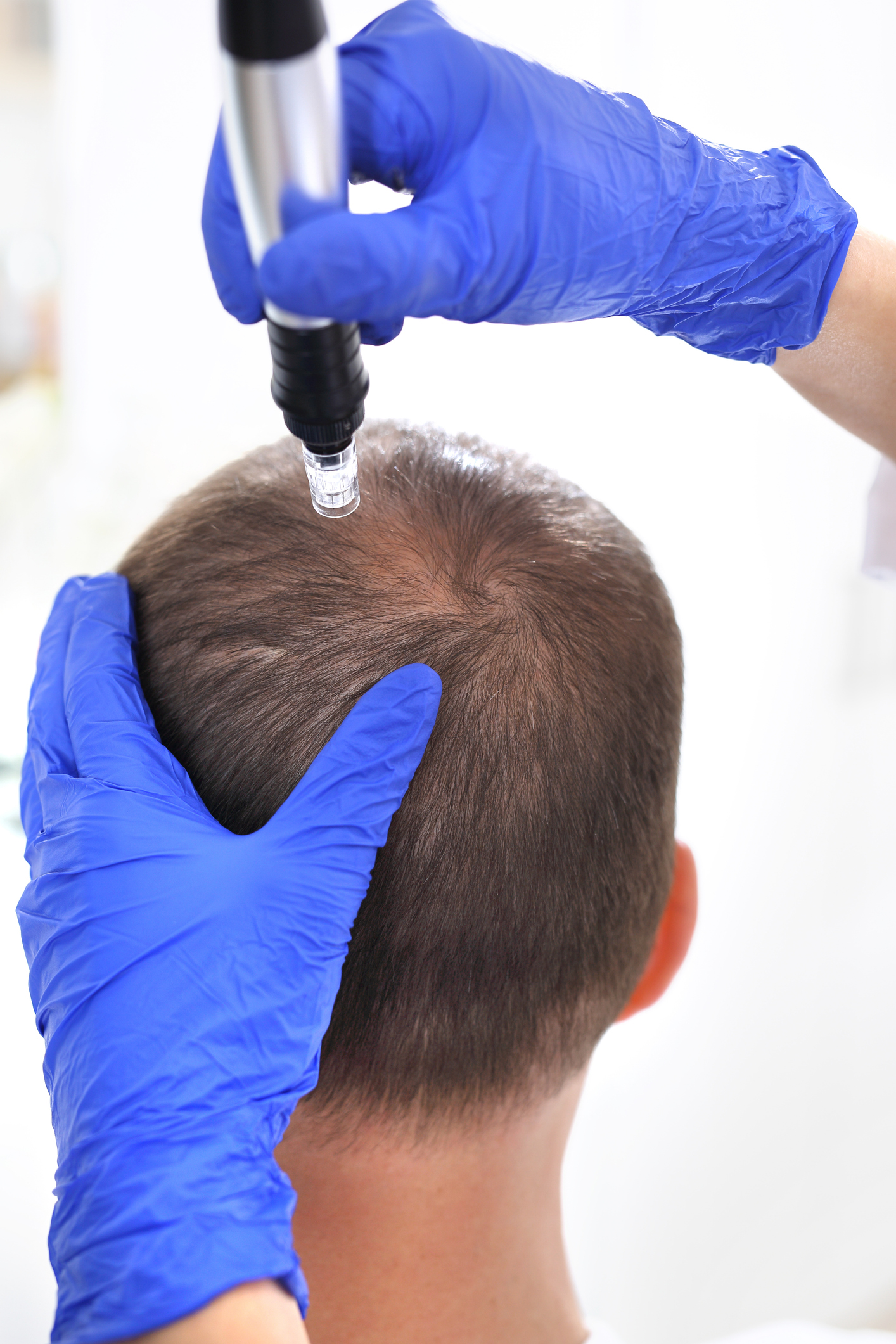 Microneedling Pro-Xo® Premium Hair