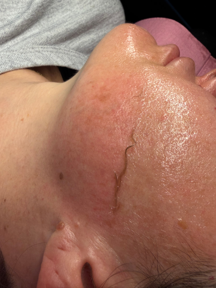 EXPRESS DERMAPLANE π