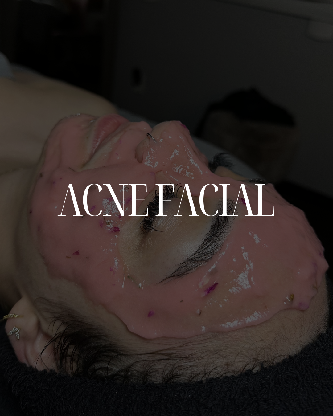 Acne Facial