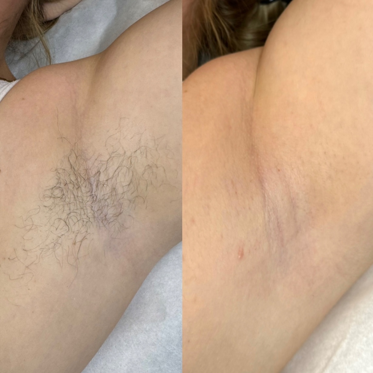 Underarms at elle's esthetics in Galesburg, IL