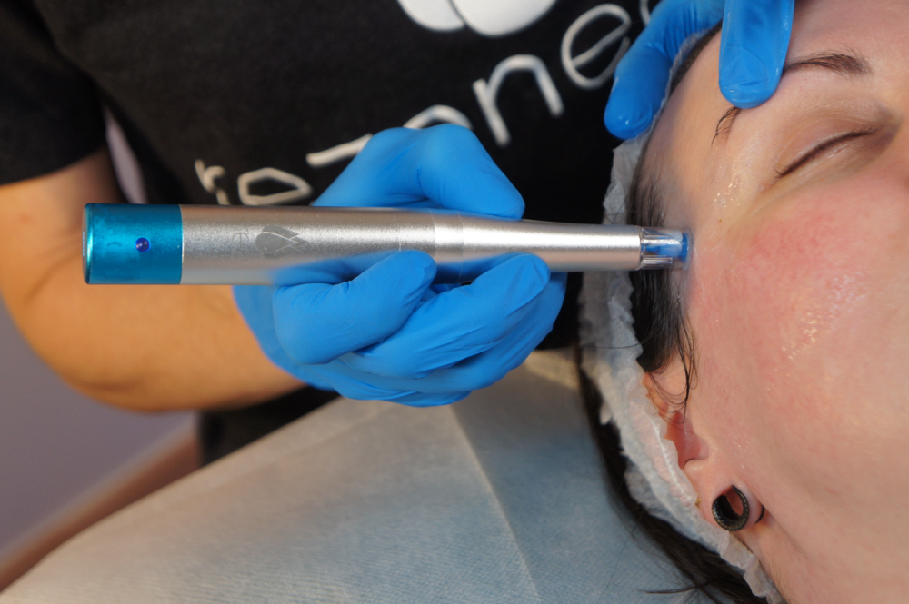 Rezenerate Nano Infusion Facial at Adrielly Martellotti in Torrance, CA