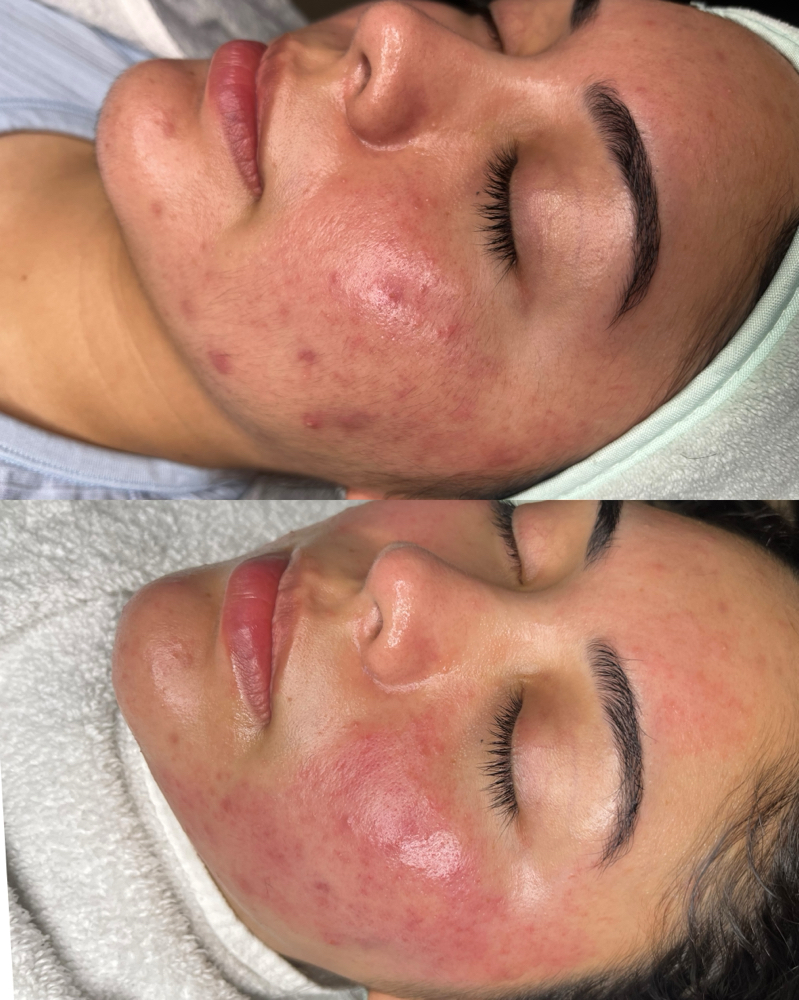Acne Fighting Facial