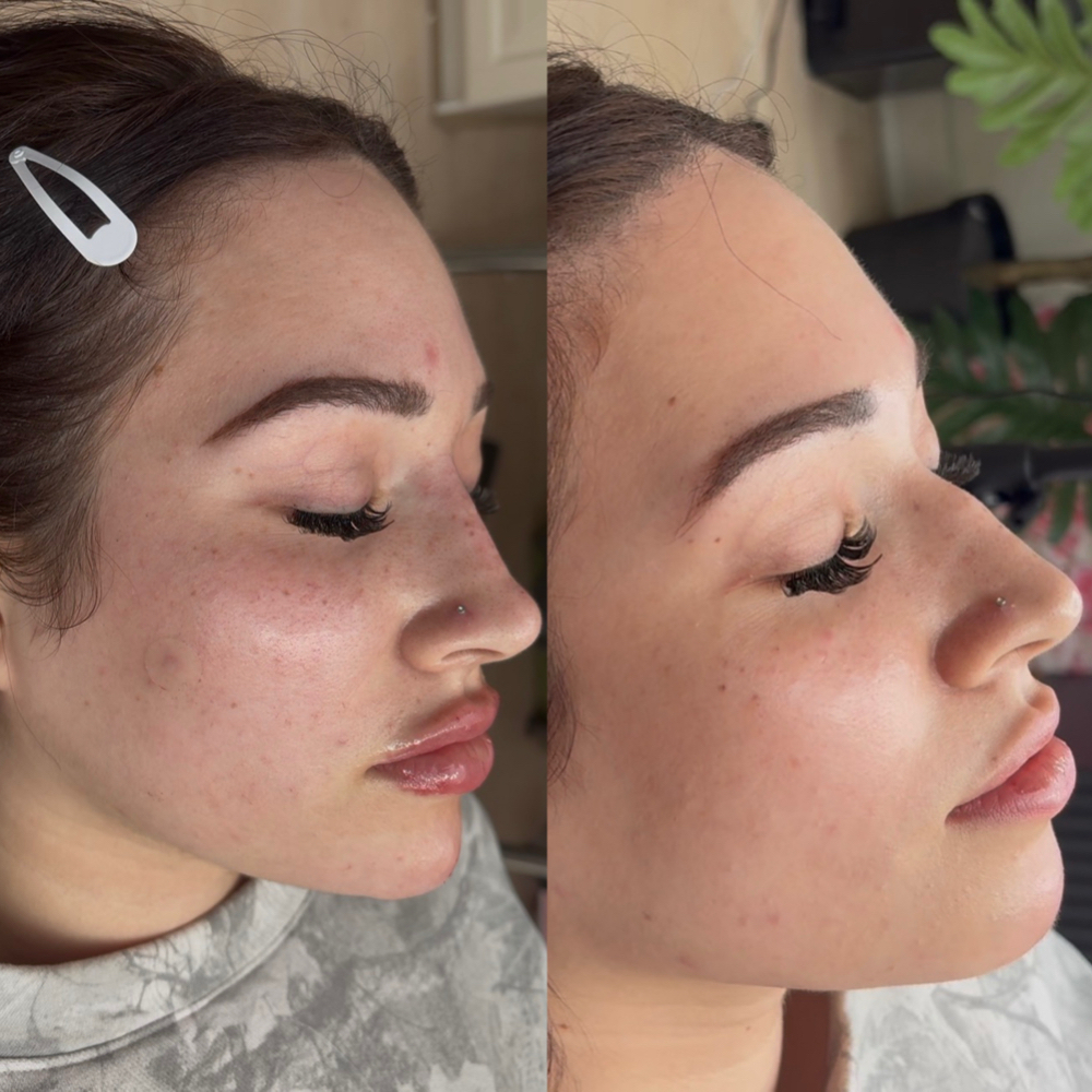 The Soft Balance 3 Ml at Balance.Bar.Aesthetics in Berkeley, CA