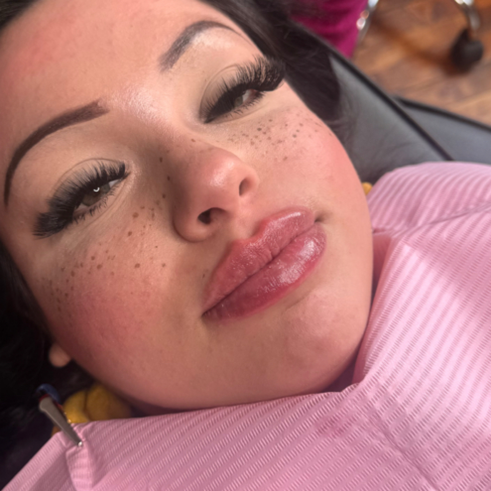Nano Needle 1ml💉👄 at Dolls.luxury.lips in Chicago, IL