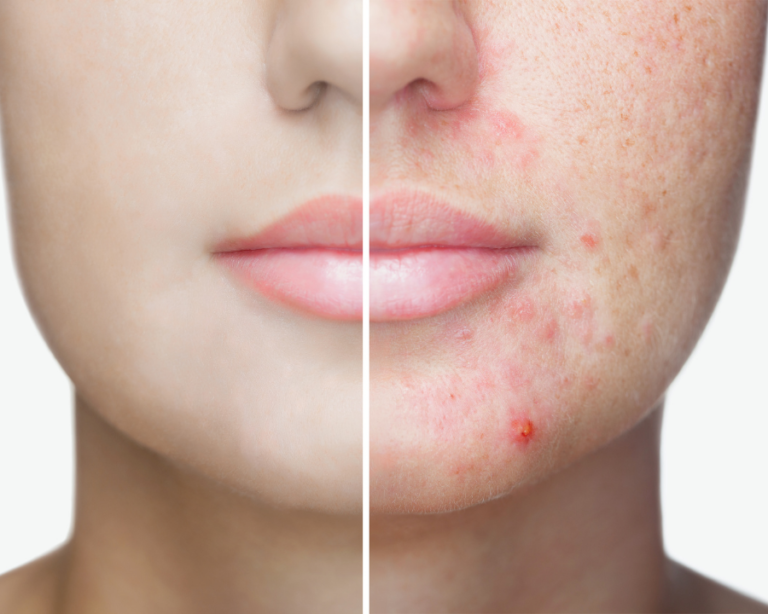 ACNE TREATMENT PACKAGE