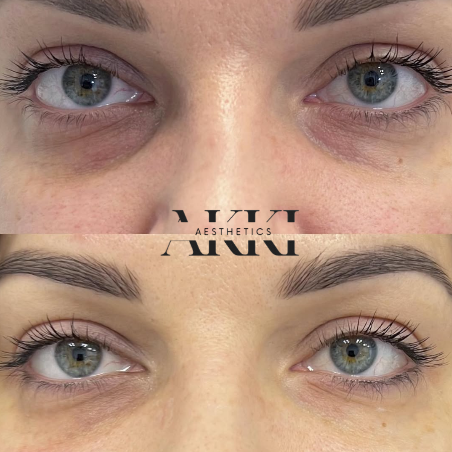 PRP Under Eye ( Liquid Gold) at Akki Aesthetics in Williston Park, NY