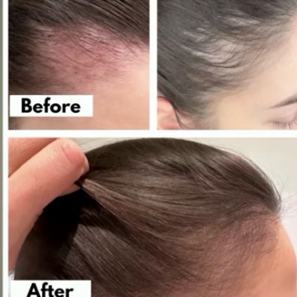 Meso therapy for Hair Growth at Eagle Eye Beauty LLC in Worcester, MA