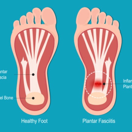 Plantar Fasciitis Targeted Massage at Flourish Health & Wellness in Howard City, MI