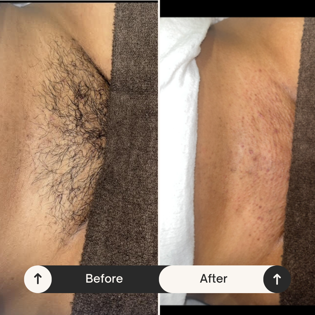 (SPRINGFIELD) Full Brazilian Wax