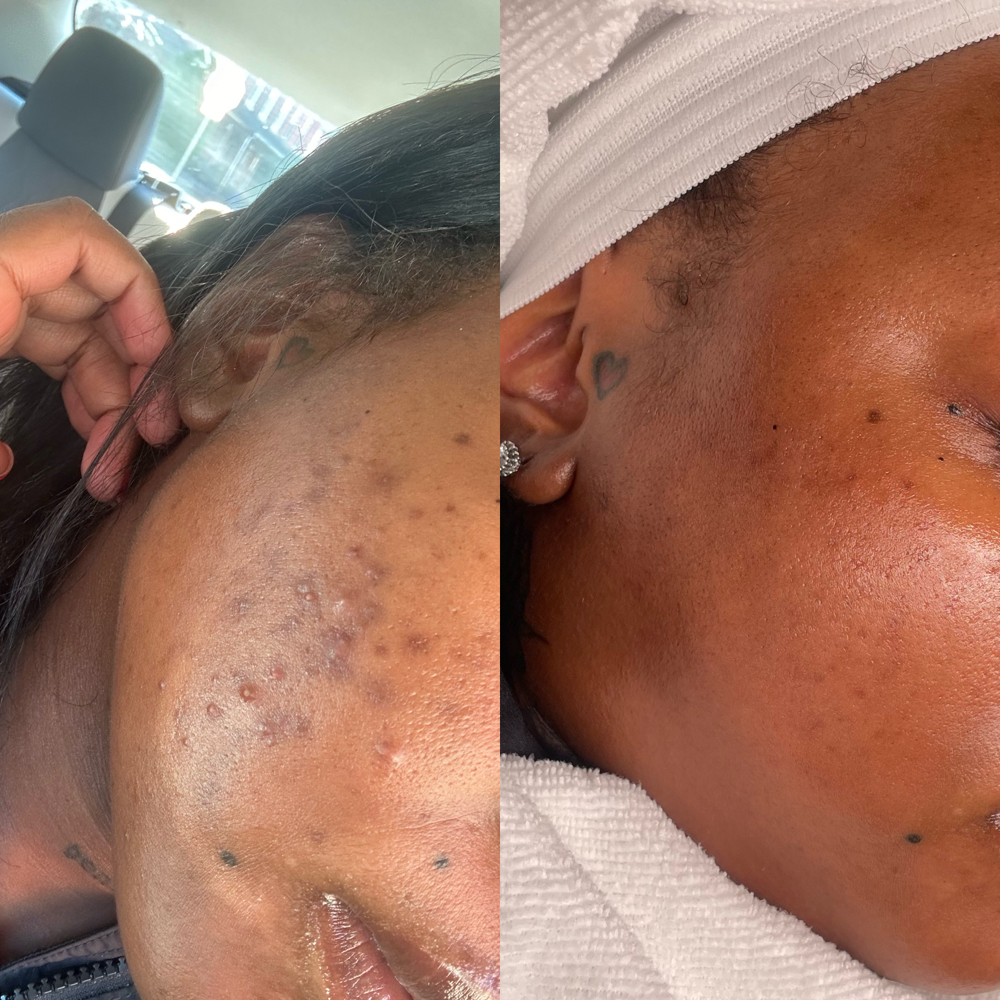 Deep Pore Treatment