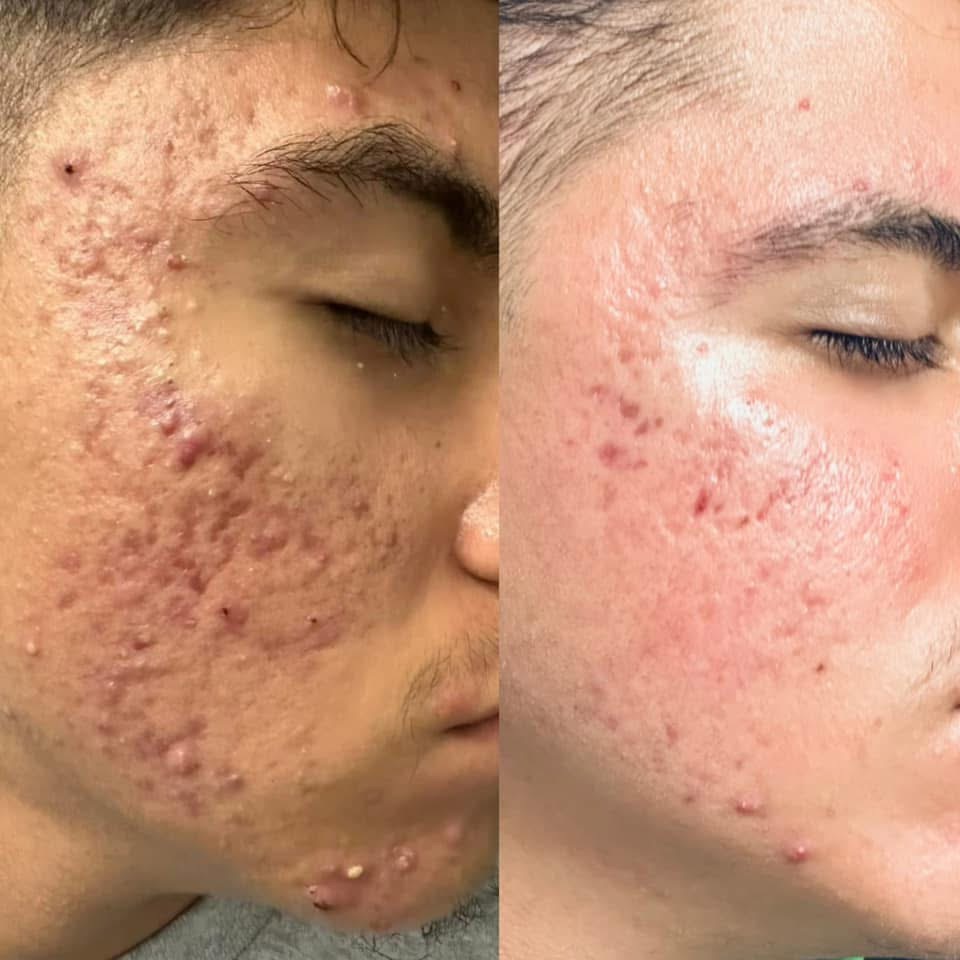 ACNE CALMING FACIAL