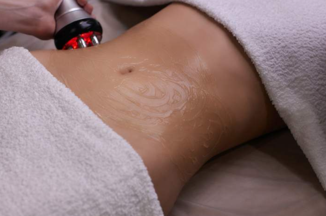 Radiofrequency skin tightening