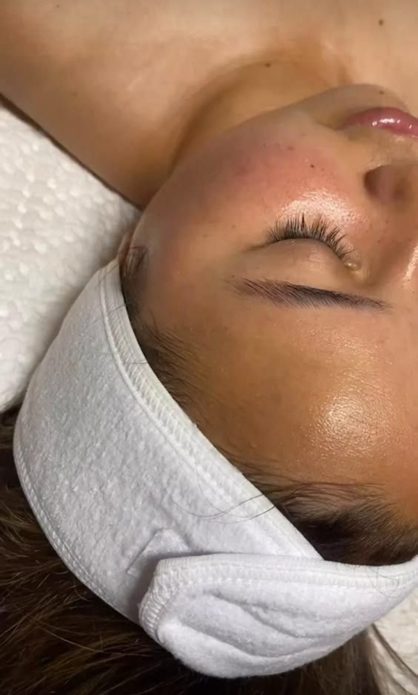 Chemical Peel