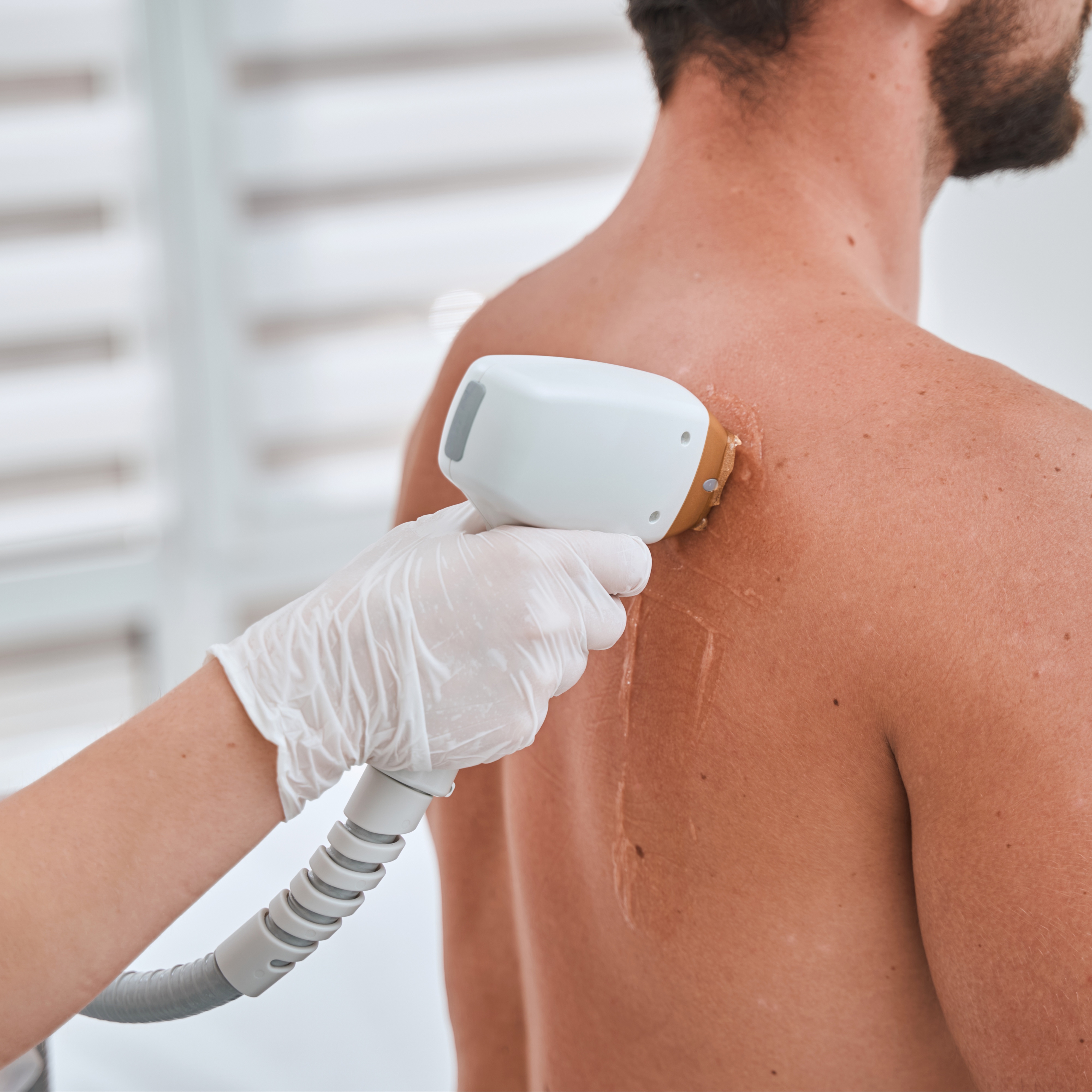 Laser Hair Removal - XL Area at 360 Med Spa Buford in Buford, GA